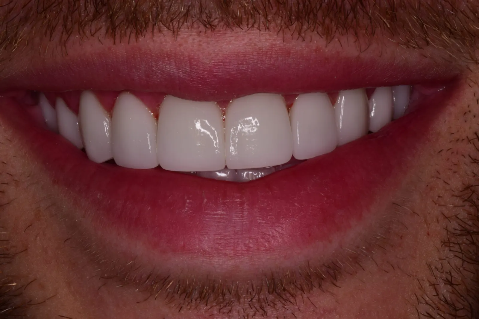 Porcelain veneers — after treatment at Merola Dental Center