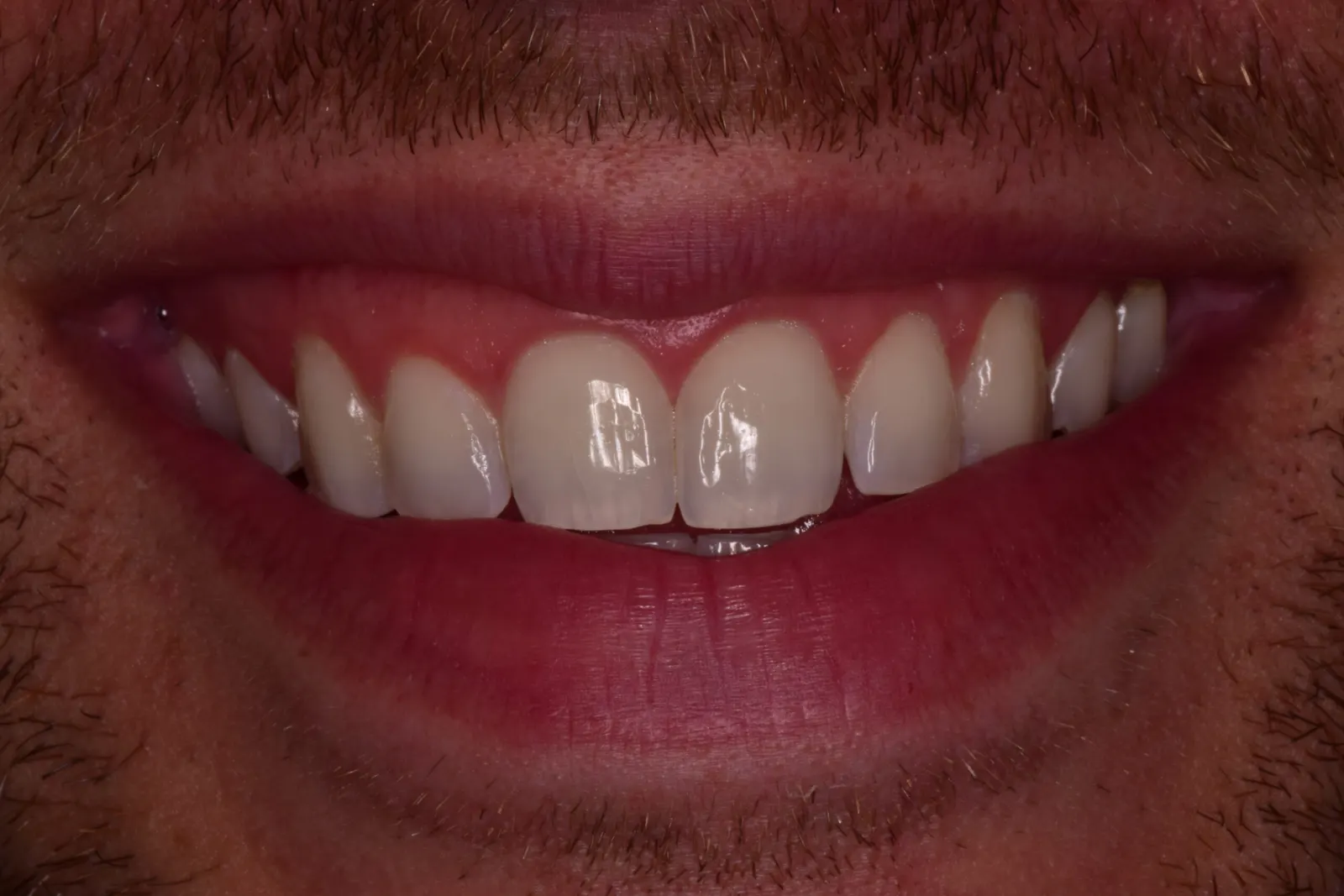 Porcelain veneers — before treatment at Merola Dental Center