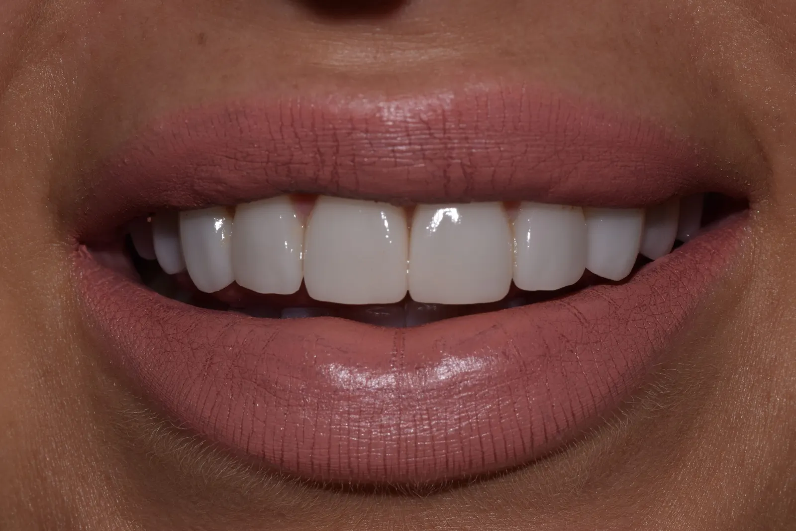 Smile restoration — after treatment at Merola Dental Center