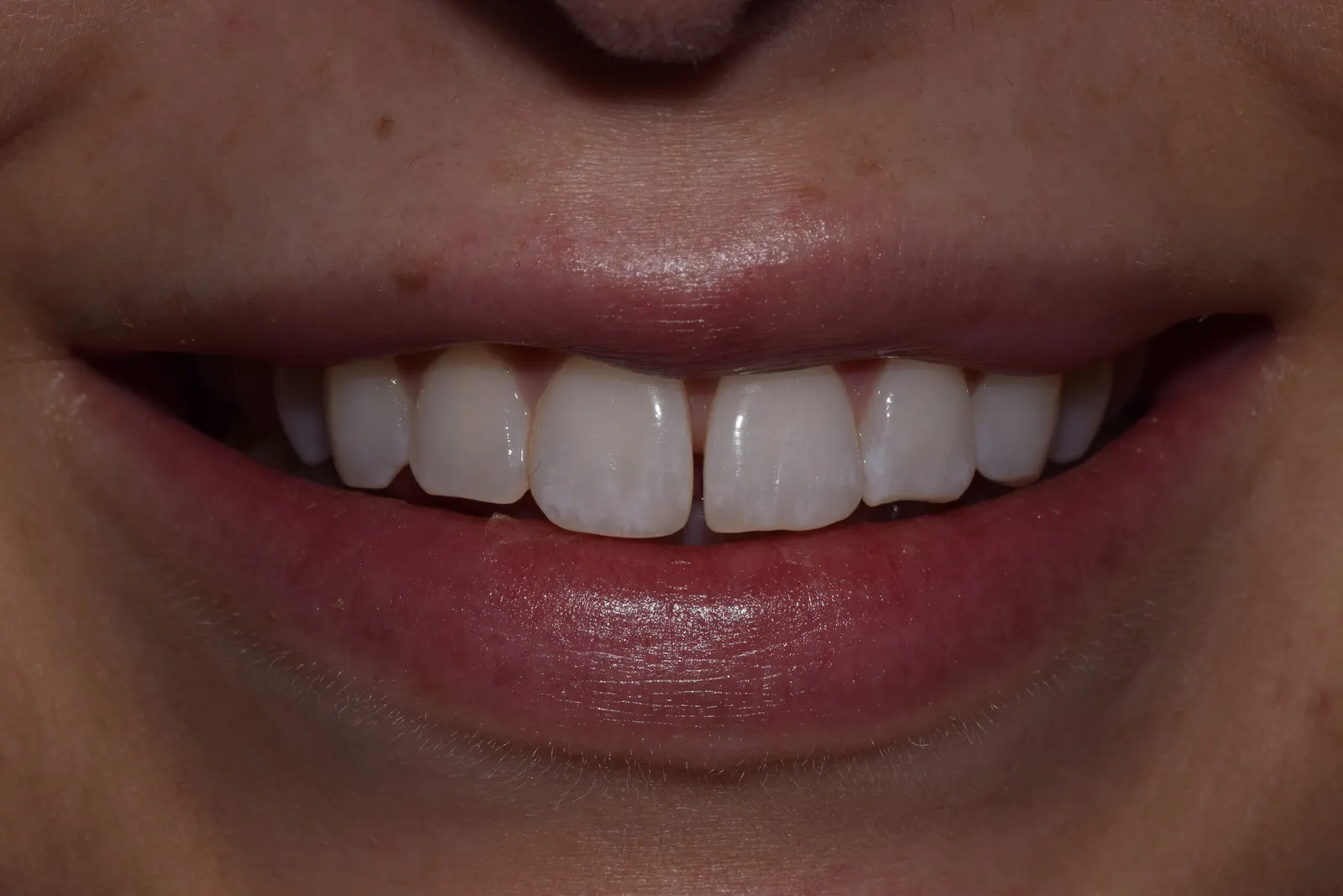 Smile restoration — before treatment at Merola Dental Center