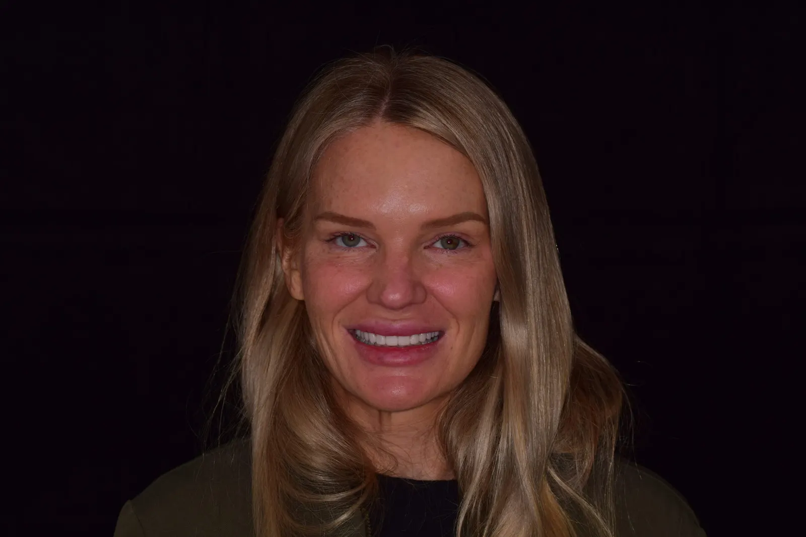 Full smile transformation — after treatment at Merola Dental Center