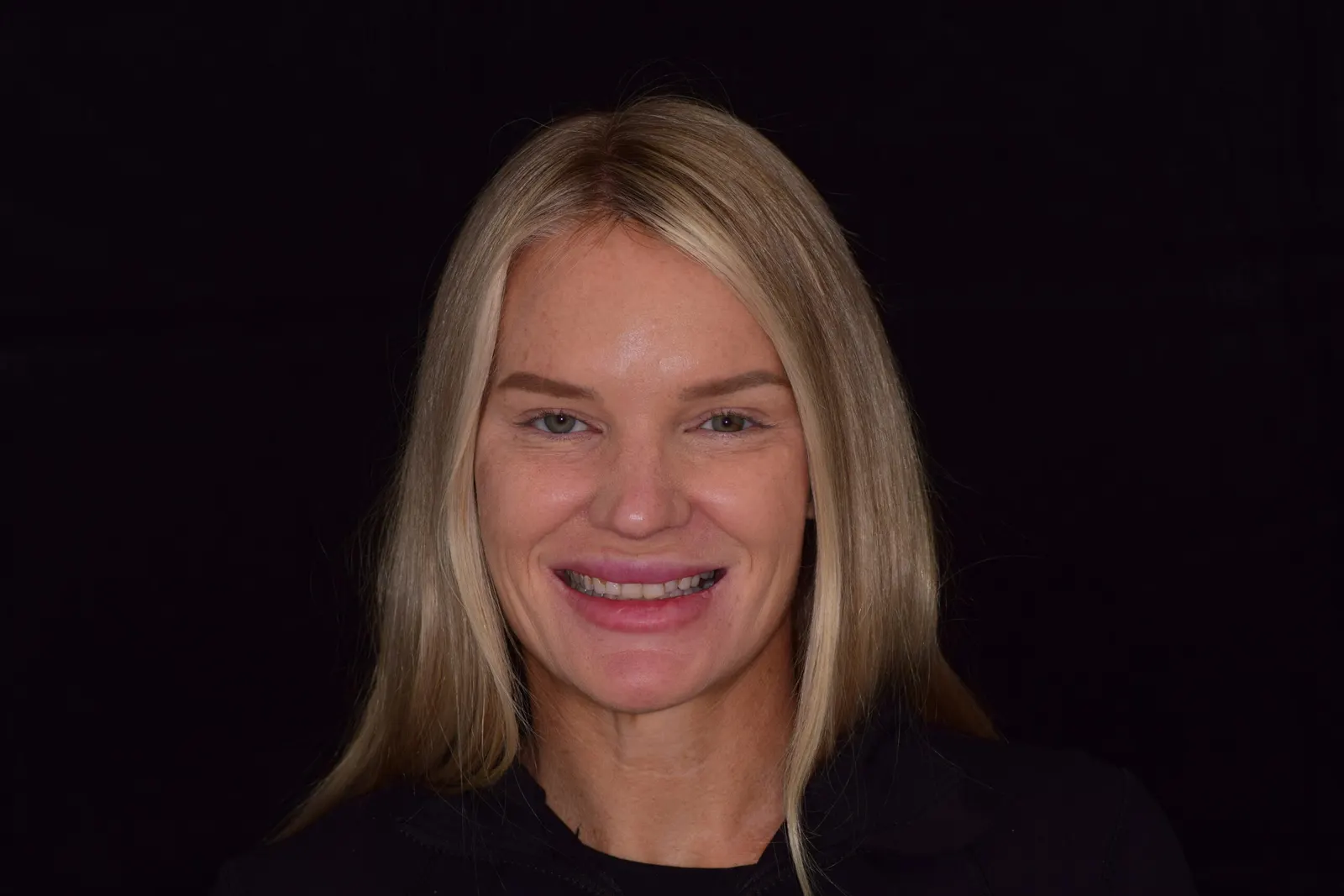 Full smile transformation — before treatment at Merola Dental Center