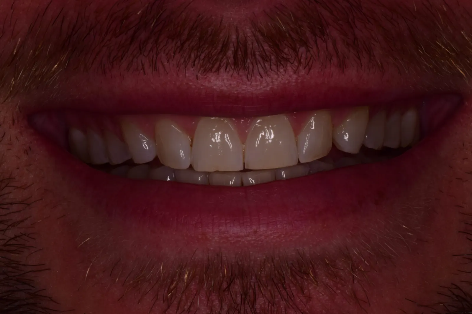 Restorative treatment — before treatment at Merola Dental Center