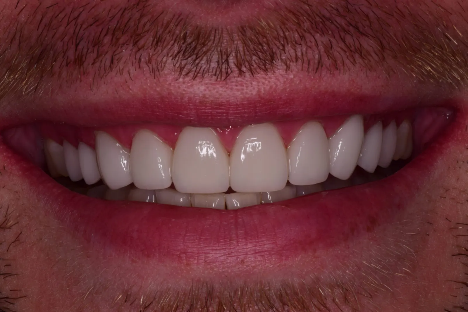Restorative treatment — after treatment at Merola Dental Center