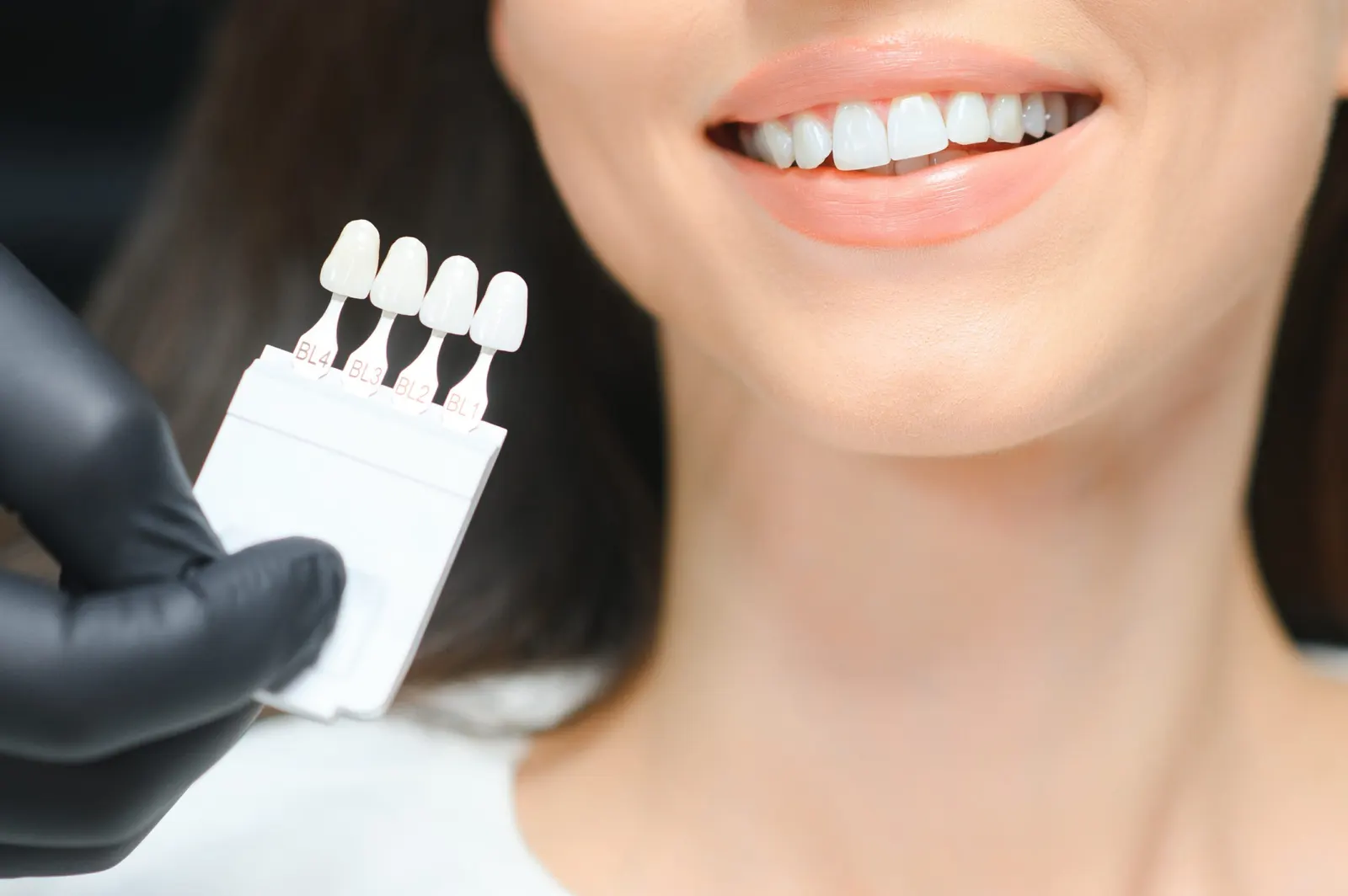 Porcelain veneer work produced at Merola Dental Center